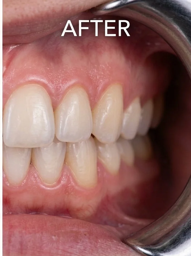Sesudah Invisalign