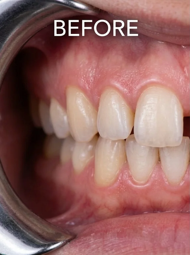 Sebelum Invisalign